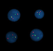 Interphase cells positive for a t(9;22) rearrangement
